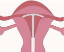 Intrauterine Device or (IUD)